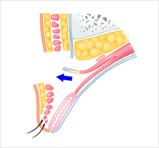 まぶ挙筋腱膜を一度瞼板から切り離し、挙筋腱膜～眼瞼挙筋を引き出します。たの裏側から表側に向け細い糸を通します