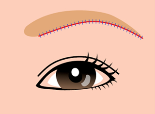 眉下切開の手術デザインの1例