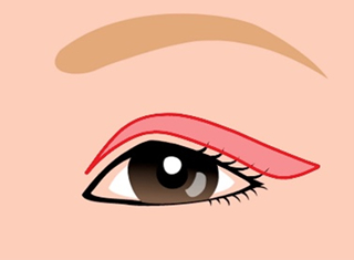 上眼瞼皮膚切除術の手術デザインの1例
