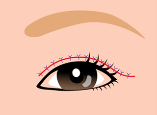 上眼瞼皮膚切除術の手術デザインの1例